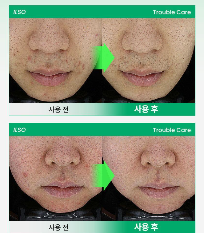 Shinee key X Ilso No Trouble Spot Softener Ampoule Pack 150g (+ 40 Cotton Sheets Gift)